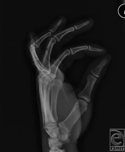 Boutonniere Deformity Following Volar Proximal Interphalangeal Joint Dislocation