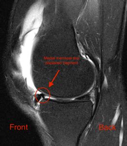 Torn Meniscus Symptoms and Diagnosis - Jeffrey H. Berg, M.D.