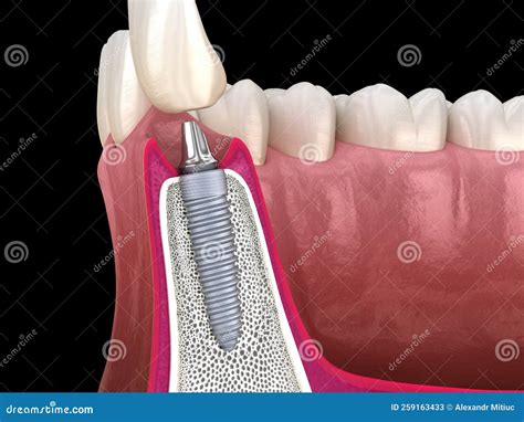 Standard Abutment Dental Implant And Ceramic Crown Medically Accurate