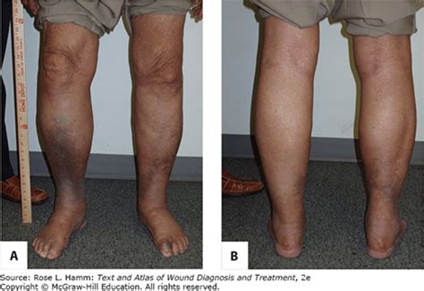 Lymphedema Musculoskeletal Key