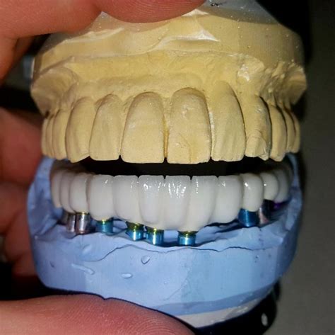 Implants High End Dental Lab