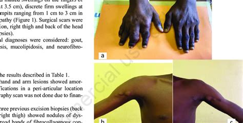 Morphological Features Show A Patient S Both Hands With Matted