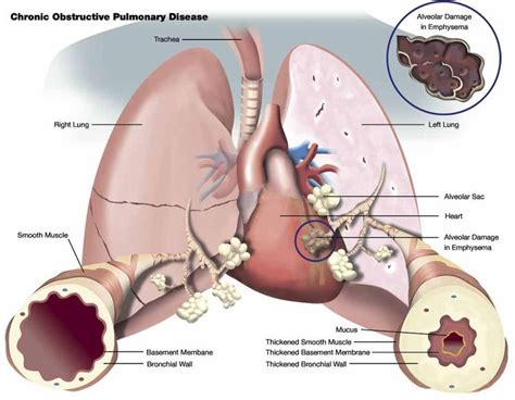 What Is COPD Exacerbation Chronic Obstructive Pulmonary Disease COPD