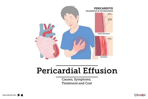 Pericarditis Causes