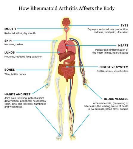 Abatacept Injection 250mg at Rs 3000/vial | in Hingna | ID: 22556062588