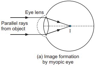 Draw a ray diagram to show the formation of the image in a myopic eye ...