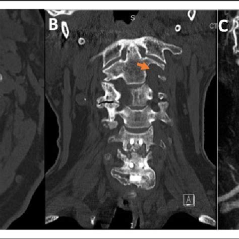 Artist Renditions A Axial View Of C2 Shows An Enlarged Transverse