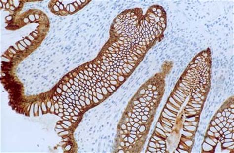 Pathology Outlines Cytokeratin Ck K