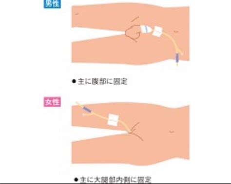 導尿バルーンの固定テープ - ジョブリッジ奮闘記