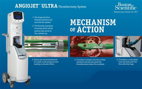 Boston Scientific 109681-001 - System Catheter Thrombectomy Angiojet ...