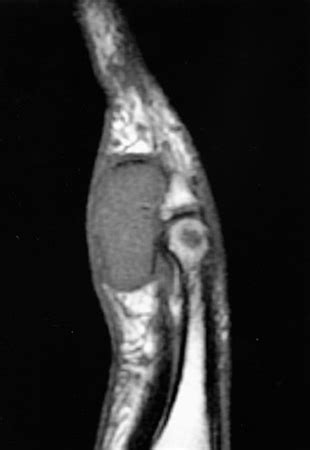 Giant Cell Tumor of Tendon Sheath - Hand - Orthobullets