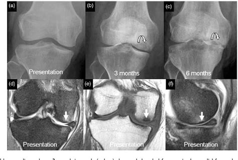 Figure 4 From Subchondral Insufficiency Fractures Of The Knee Review