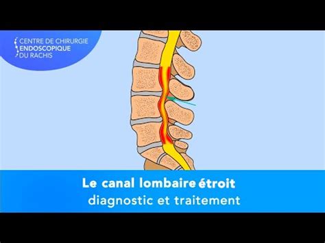 Sténose du canal rachidien lombaire les symptômes