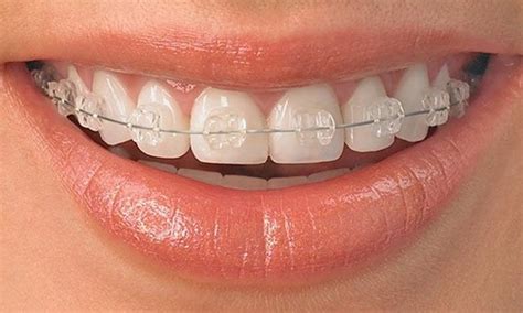 Son buenos los brackets de porcelana o hay otros más recomendables