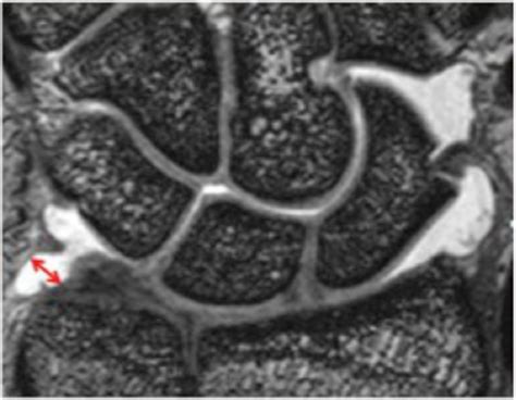 Figure 1 From Prestyloid Recess Of The Wrist Normal Appearance On 3t