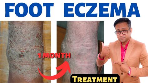 Foot Eczema Treatment Atopic Dermatitis Hindi Youtube