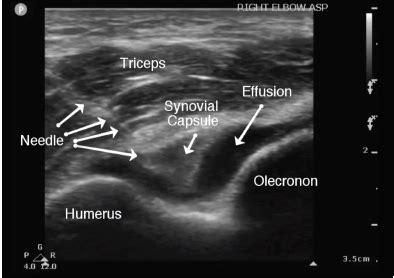 Point Of Care Ultrasound Directed Evaluation Of Elbow Effusion The