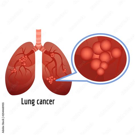 Lung Cancer Icon Cartoon Of Lung Cancer Vector Icon For Web Design