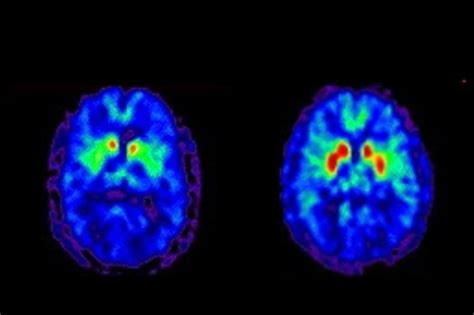 Parkinson Ein Biomarker Weist Schon Jahrzehnte Vor Ersten Symptomen