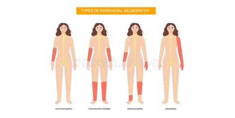 Peripheral Neuropathy Medical Poster Stock Vector - Illustration of ...