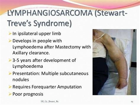 Lymphangiosarcoma = Stewart Treve syndrome ... 【 Note: After Mastectomy ...