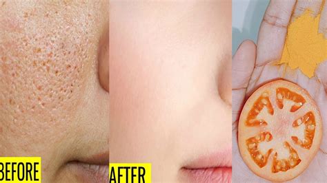 How To Close Open Pores Permanently Open Pores Treatment At Home