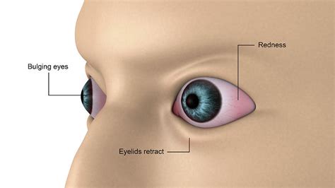 Medical Illustration Of Exophthalmos Photograph by Stocktrek Images ...