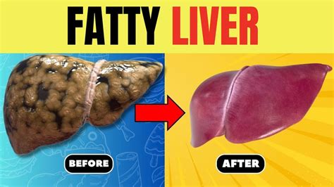 Strictly Avoid These 5 Foods If You Have Fatty Liver Fatty Liver