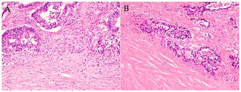 Histopathological Features Of Desmoplastic Reactions Are Shown For A