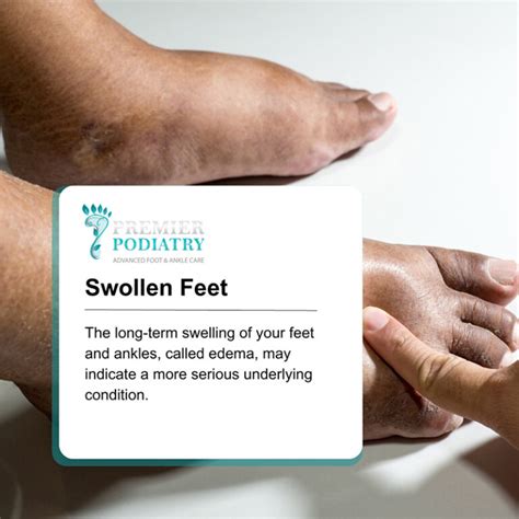 Swollen Feet Premier Podiatry Velimir Petkov Dpm Podiatrists