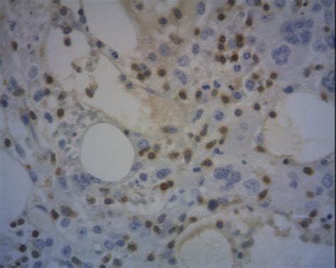 Figure From Hemophagocytic Syndrome Secondary To Adult Onset Still S