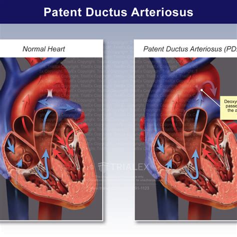 The Ductus Arteriosus Before And After Birth Trial Exhibits Inc