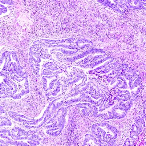 Gastric Adenocarcinoma Gc Hande—original Magnification 40x Download Scientific Diagram