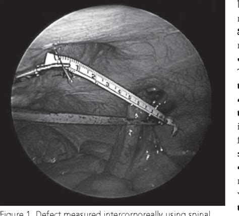 Figure 1 From Laparoscopic Repair Of Incisional And Other Complex