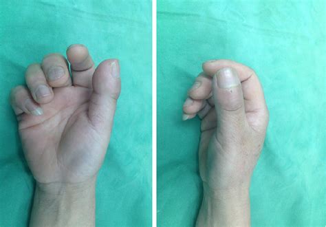 Figure 1 From Enchondroma In The Distal Phalanx Of The Thumb With