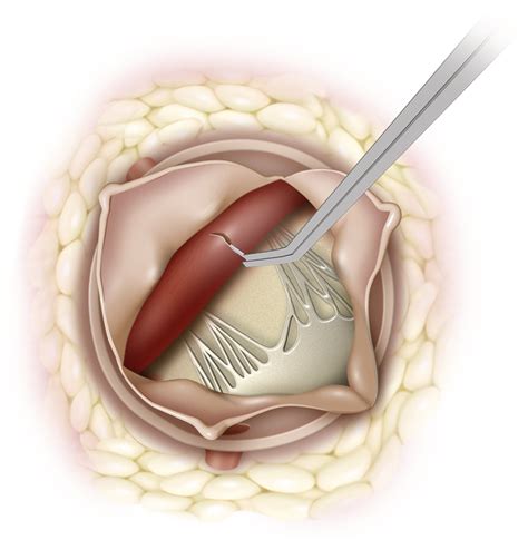 View Of Left Ventricular Outflow Tract Lvot From Aorta With Aortic