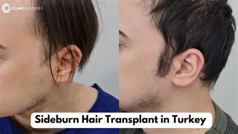 Hair Restoration In Turkey Clinicadvisor