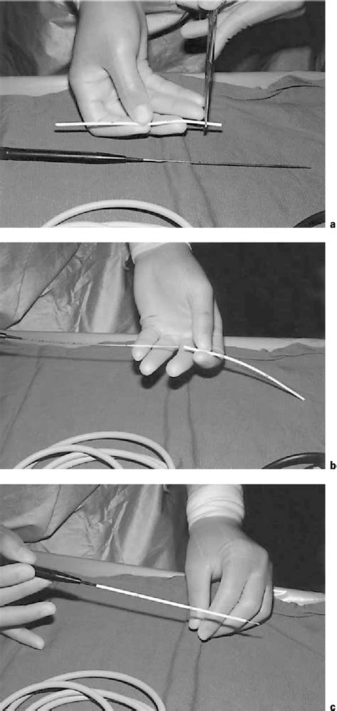 Figure 1 From A Simple And Safe Technique For Endoscopic Third Ventriculocisternostomy