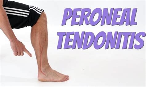 Best Peroneal Tendonitis Exercises To Restore Function