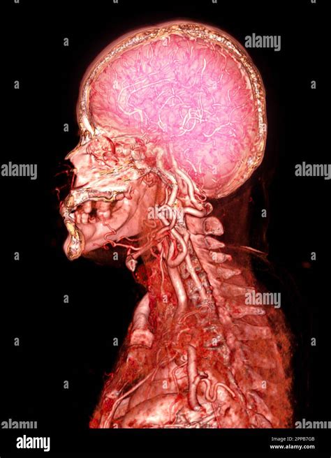 Cta Brain And Carotid Artery Or Ct Angiography Of The Brain 3d