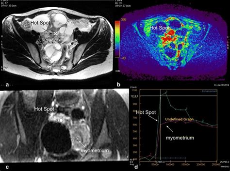 Technical Assessment Of Dce Mr Imaging In Complex Adnexal Masses This