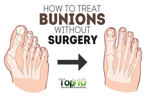 How To Treat Bunions Without Surgery Top 10 Home Remedies