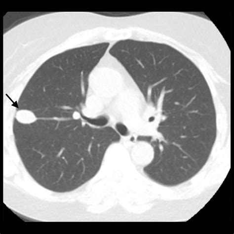 American Journal Of Case Reports Cryptococcus Neoformans Presenting As A Lung Mass In An