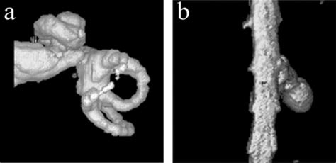 MRI image of the vestibular apparatus (a) and extracted (virtually)... | Download Scientific Diagram