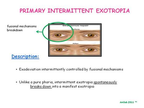 Syah's Optometry Blog: EXOTROPIA