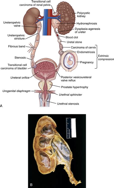 Alterations Of Renal And Urinary Tract Function Basicmedical Key