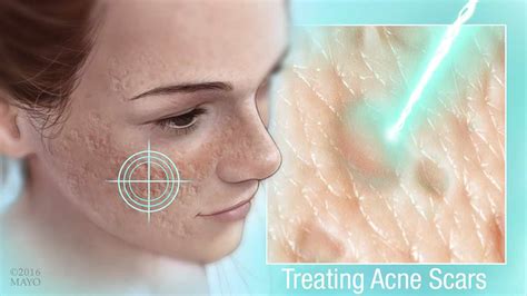 Mayo Clinic Q and A: Treatment Options for Acne Scars That Don’t ...