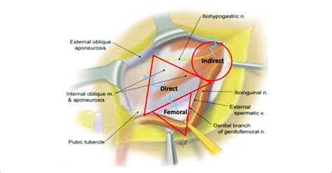 Open Inguinal Hernia Releasing Incisions Indirect Direct And Download Scientific Diagram