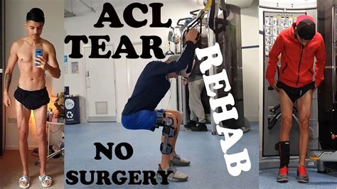 How I Torn My ACL And What Exercises I Did To Recover Non Surgical