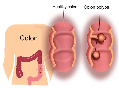 Colon Polyp And Cancer Digestive And Liver Health Specialists